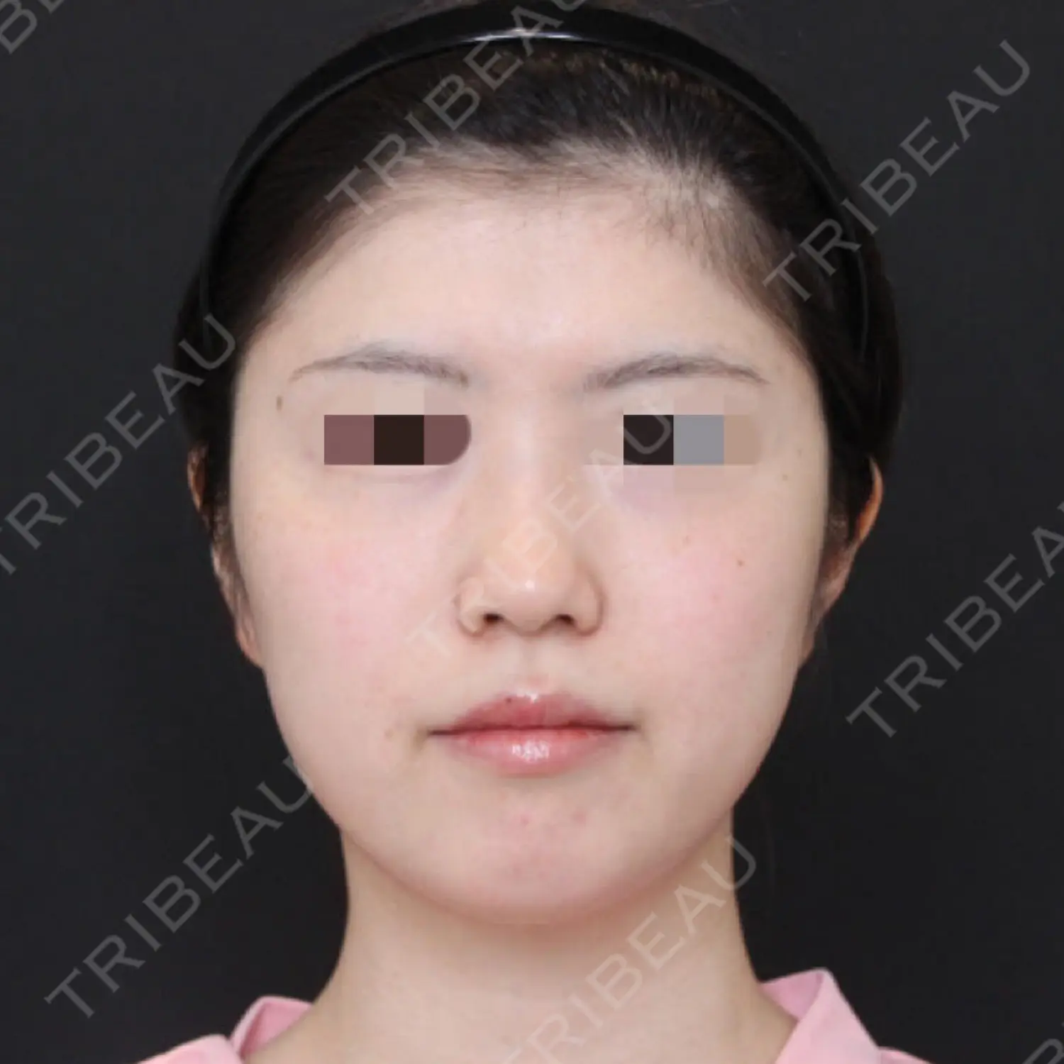 施術前の写真