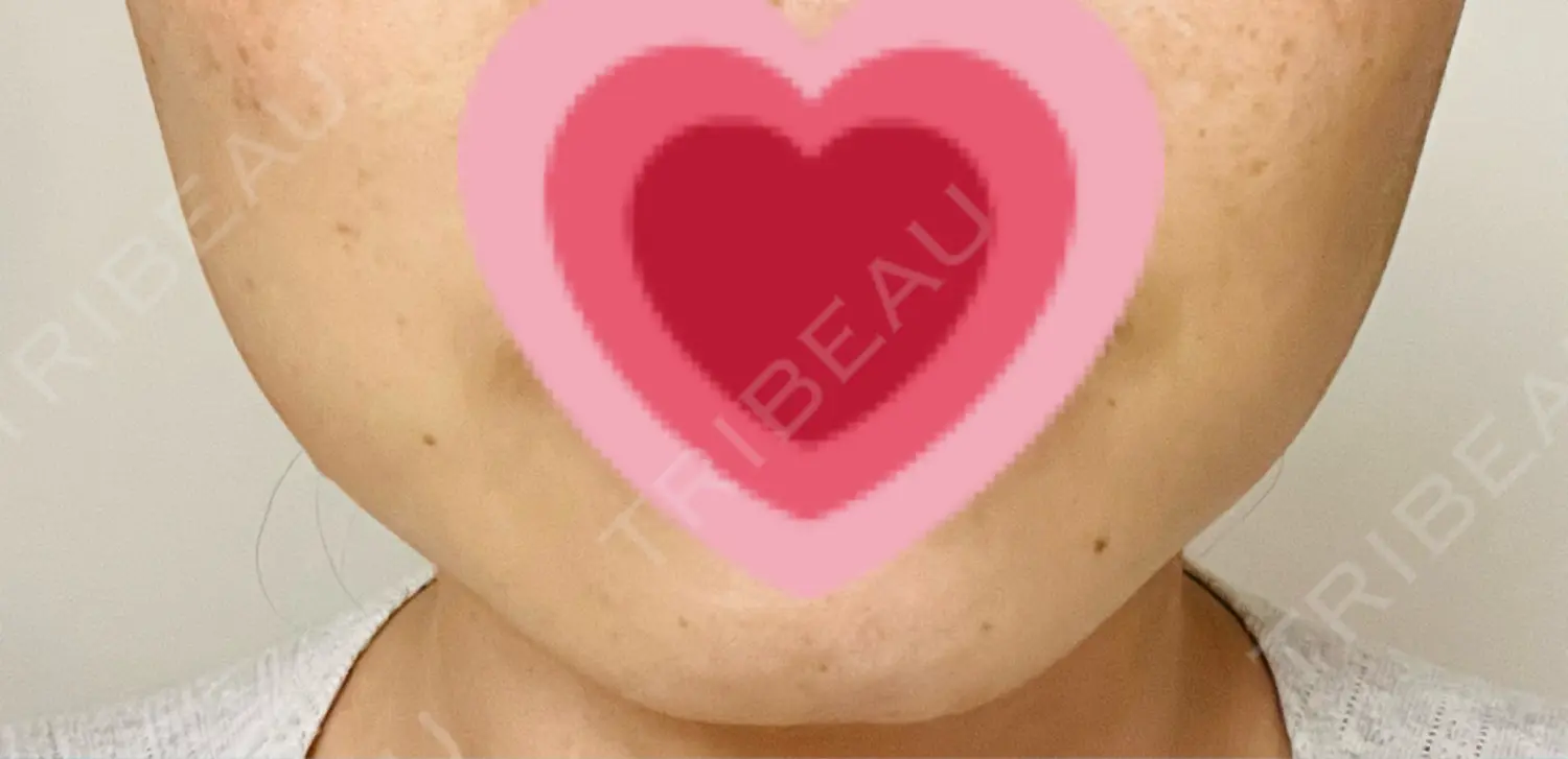 施術前の写真