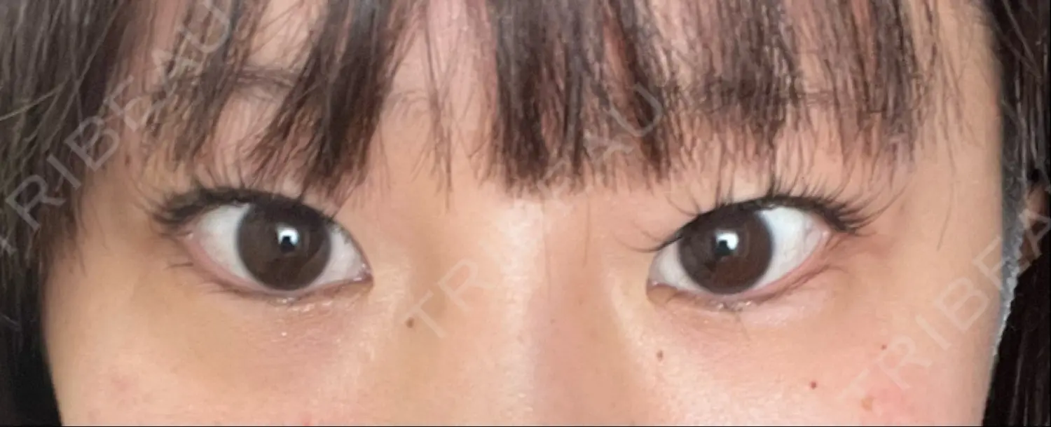 施術前の写真