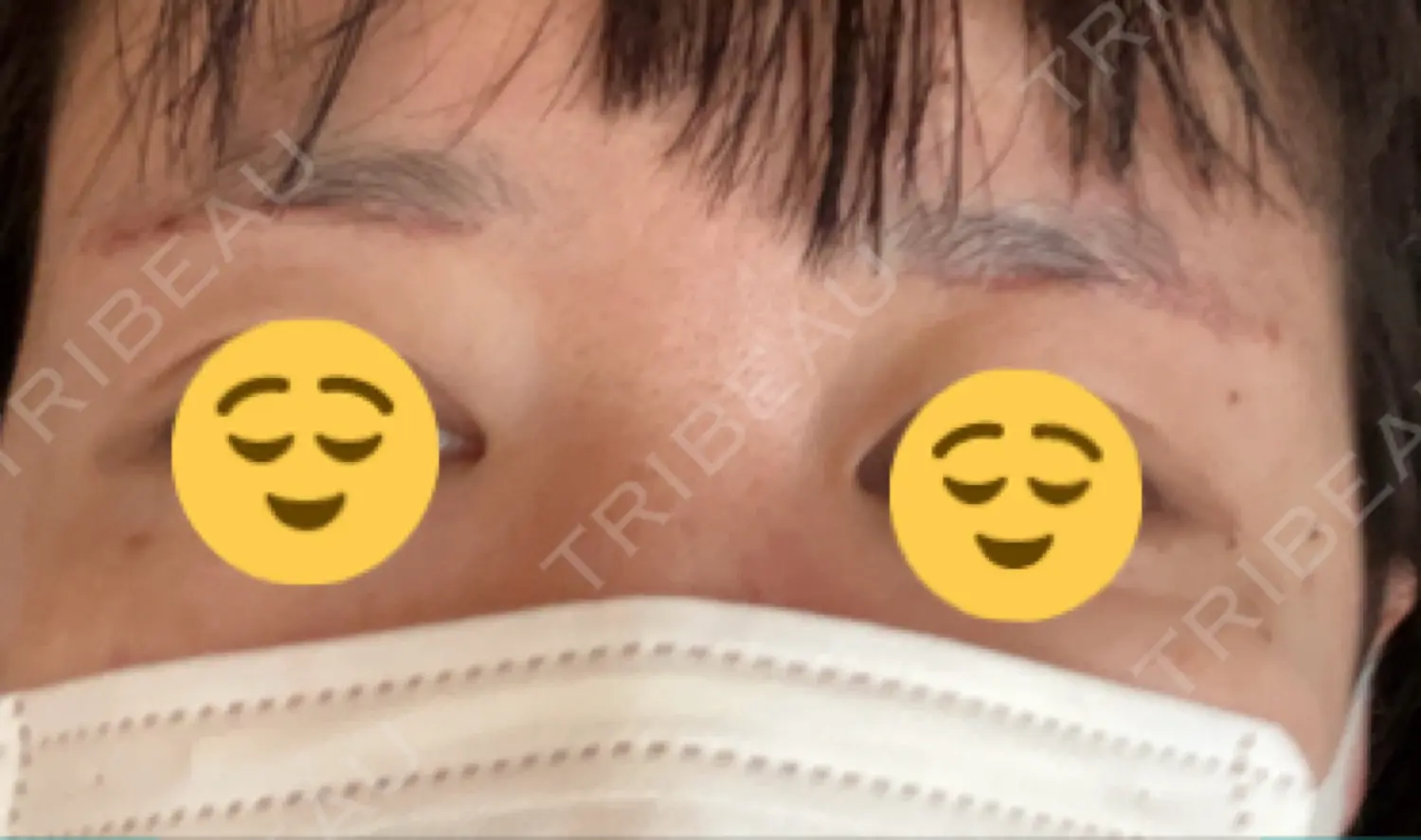 施術前の写真