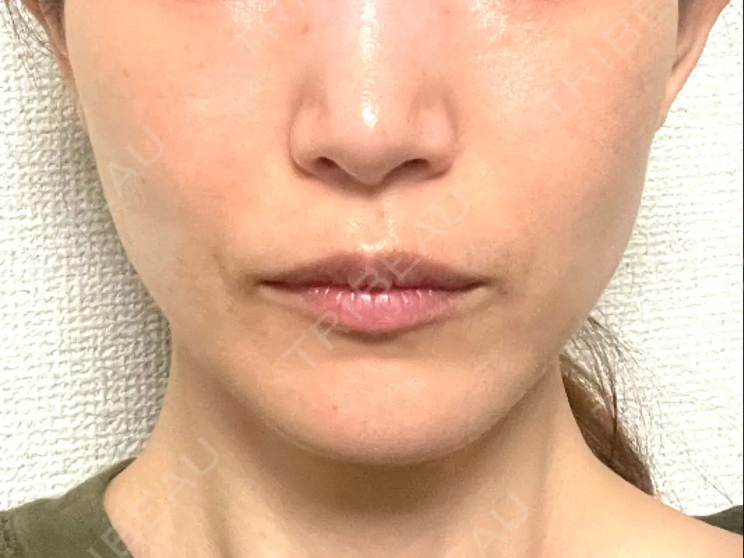 施術前の写真