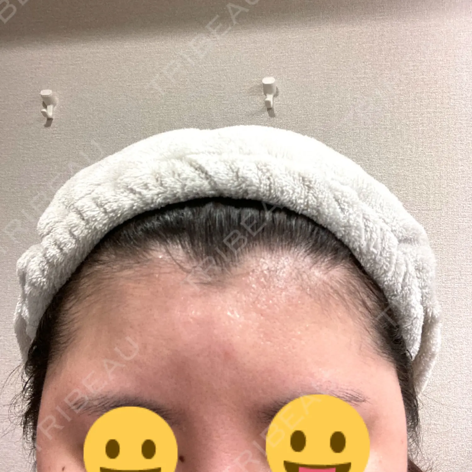 施術前の写真