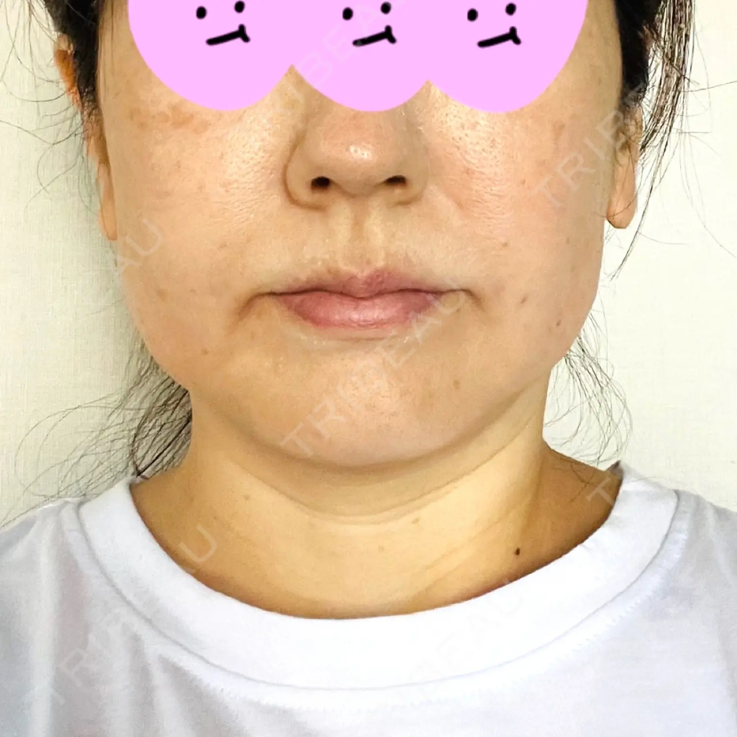 施術前の写真