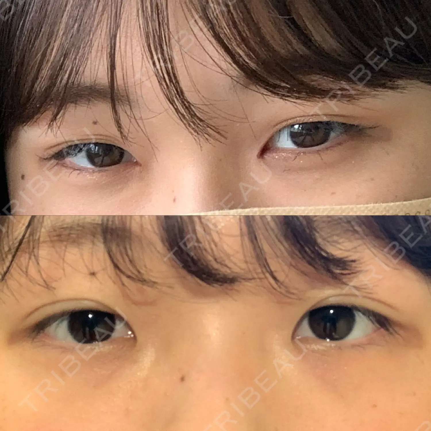 施術前の写真