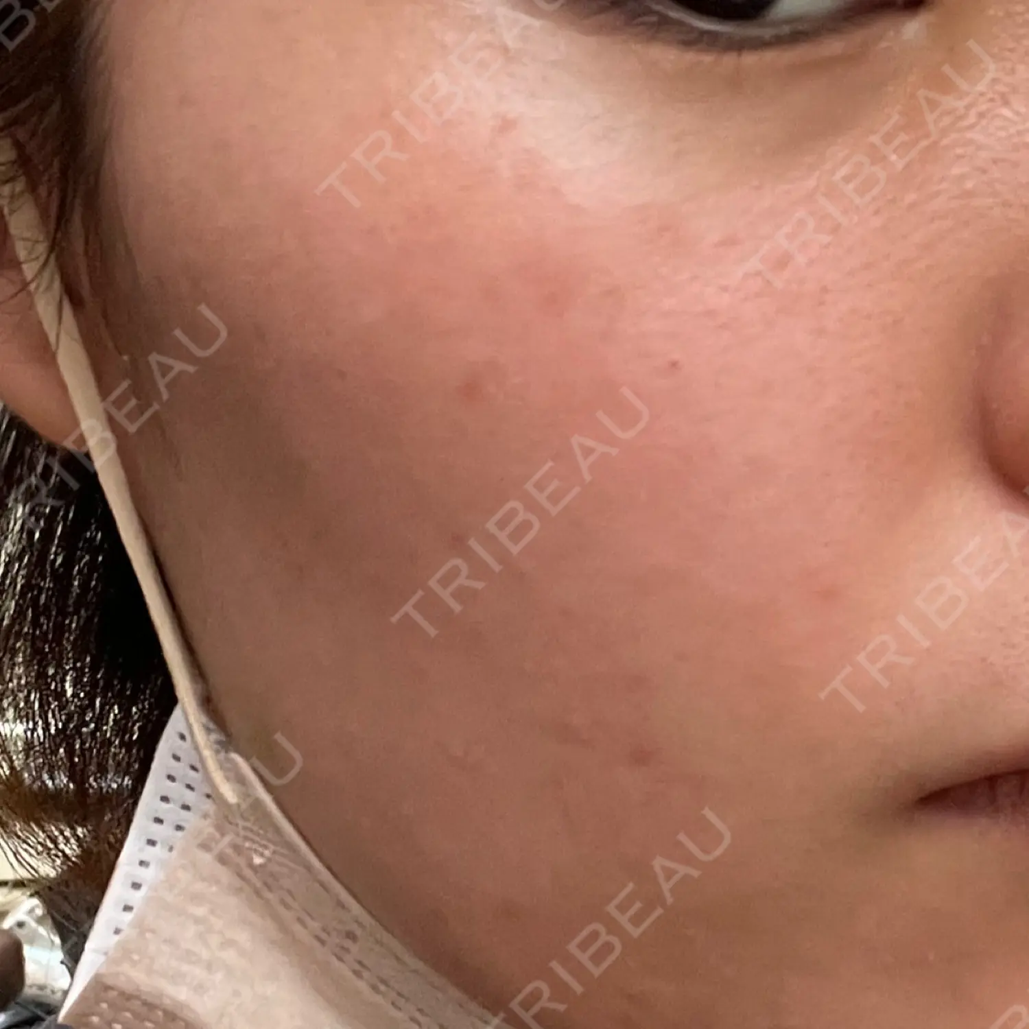 施術前の写真