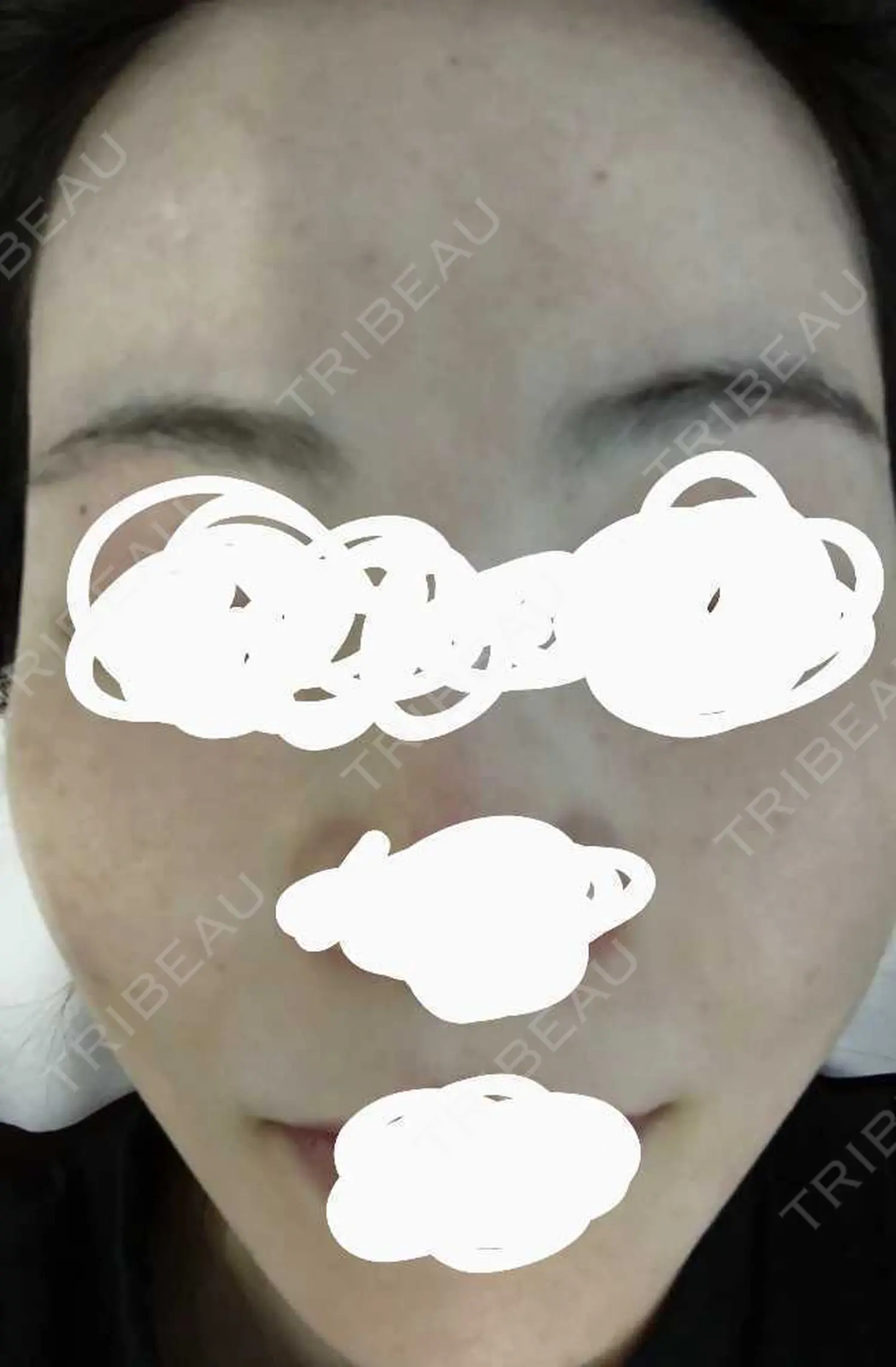 施術前の写真