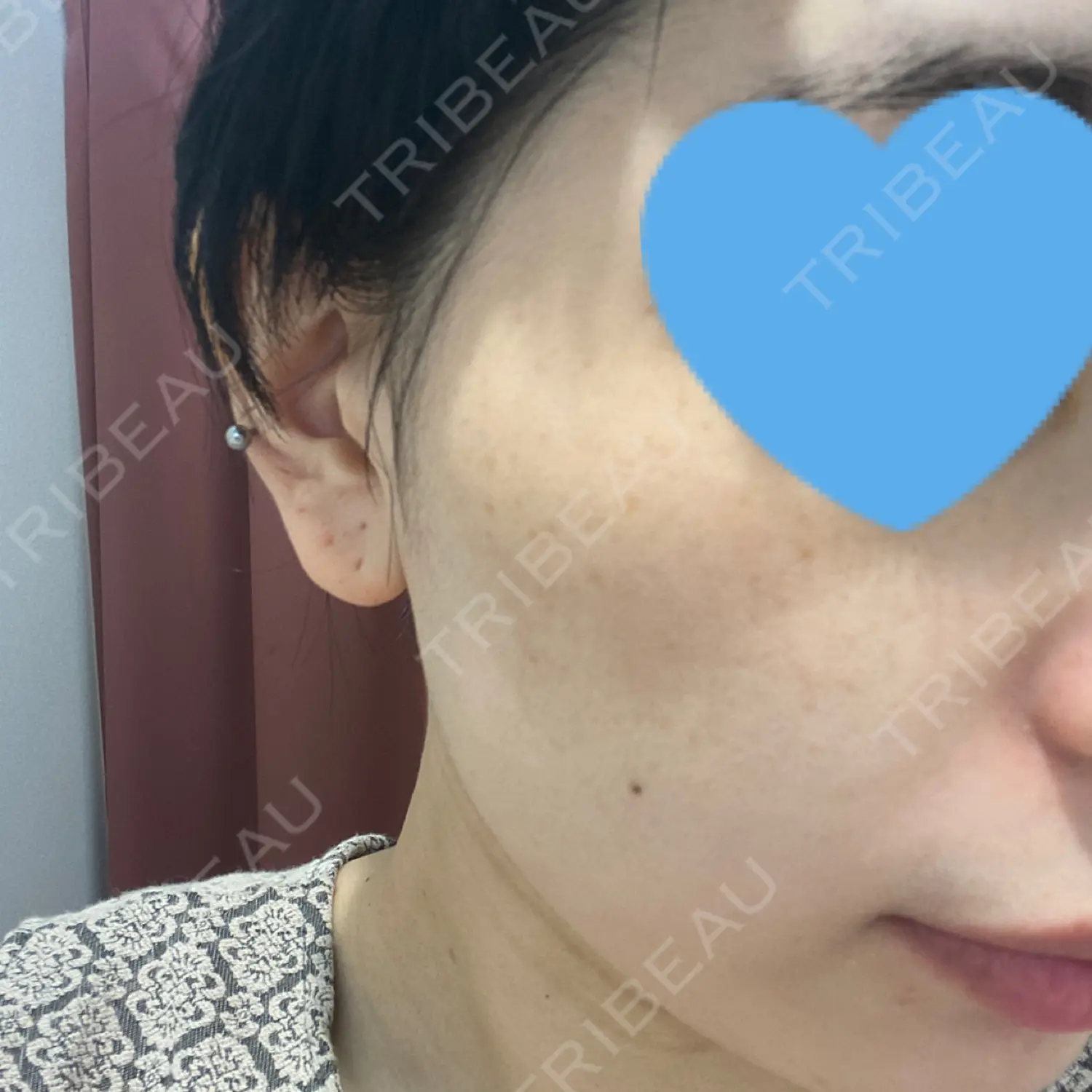 施術前の写真