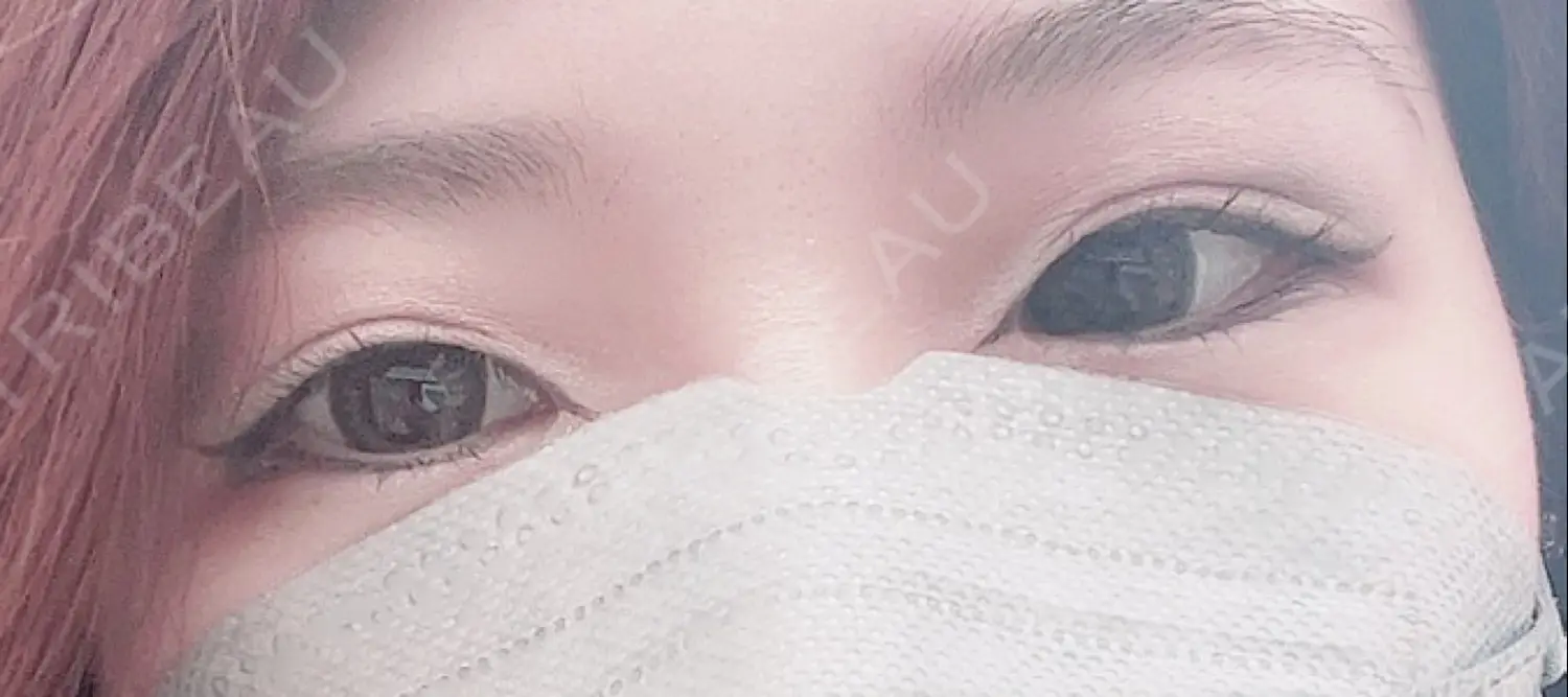 施術前の写真