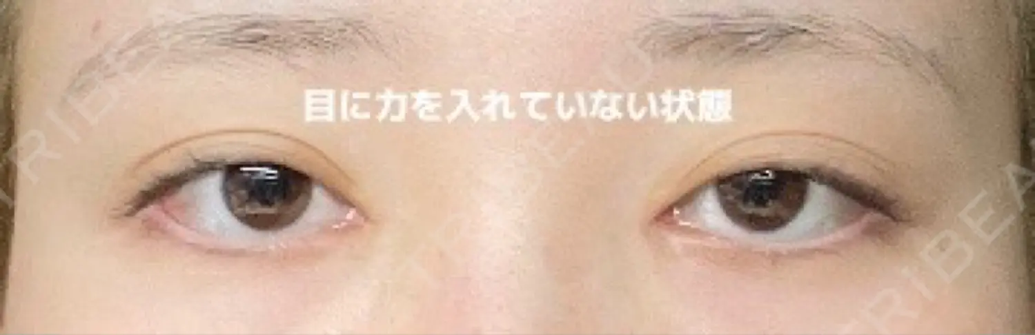施術前の写真