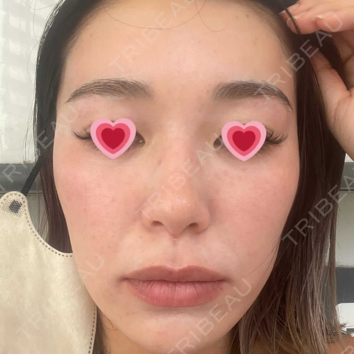 施術前の写真