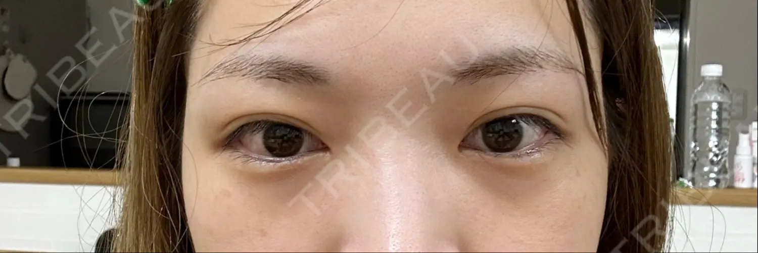 施術前の写真