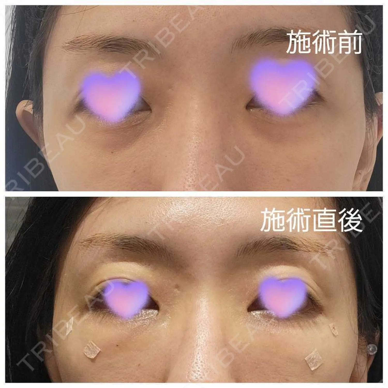 施術前の写真
