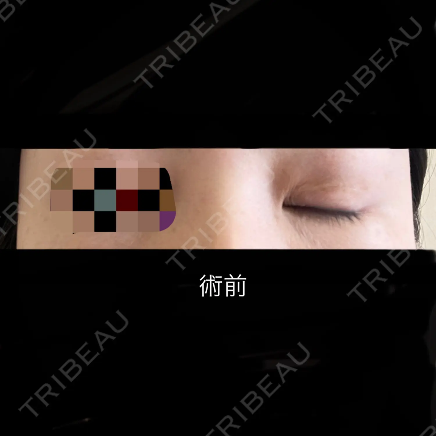 施術前の写真