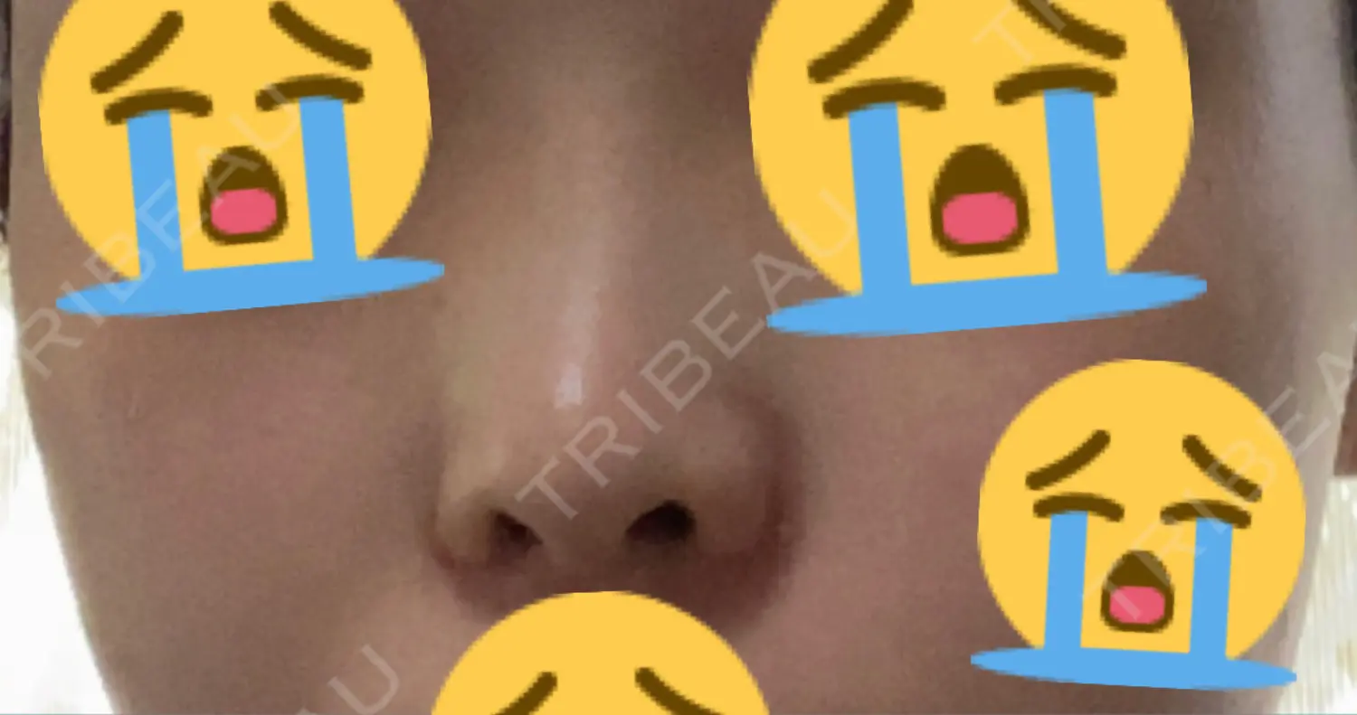 施術前の写真