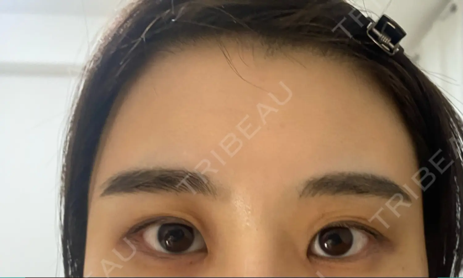 施術前の写真