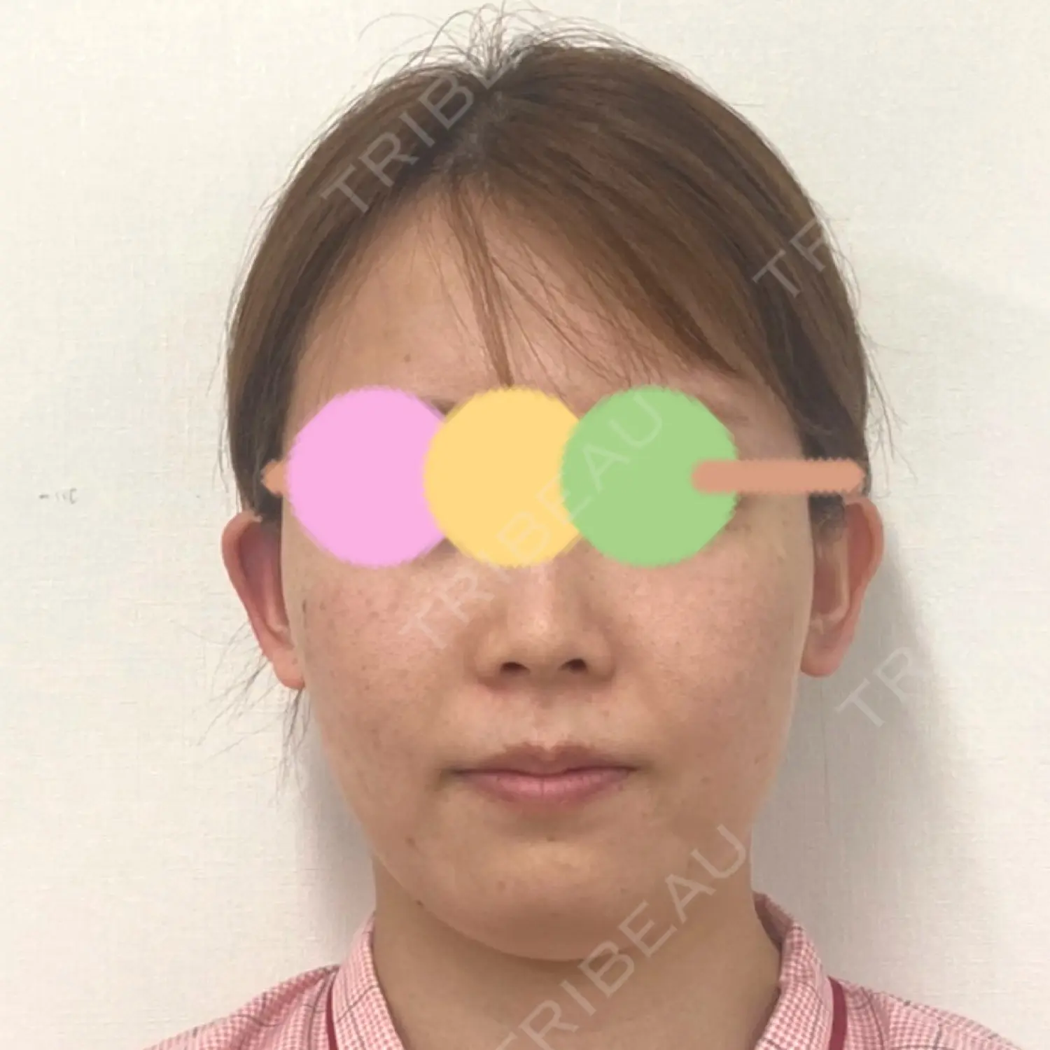 施術前の写真