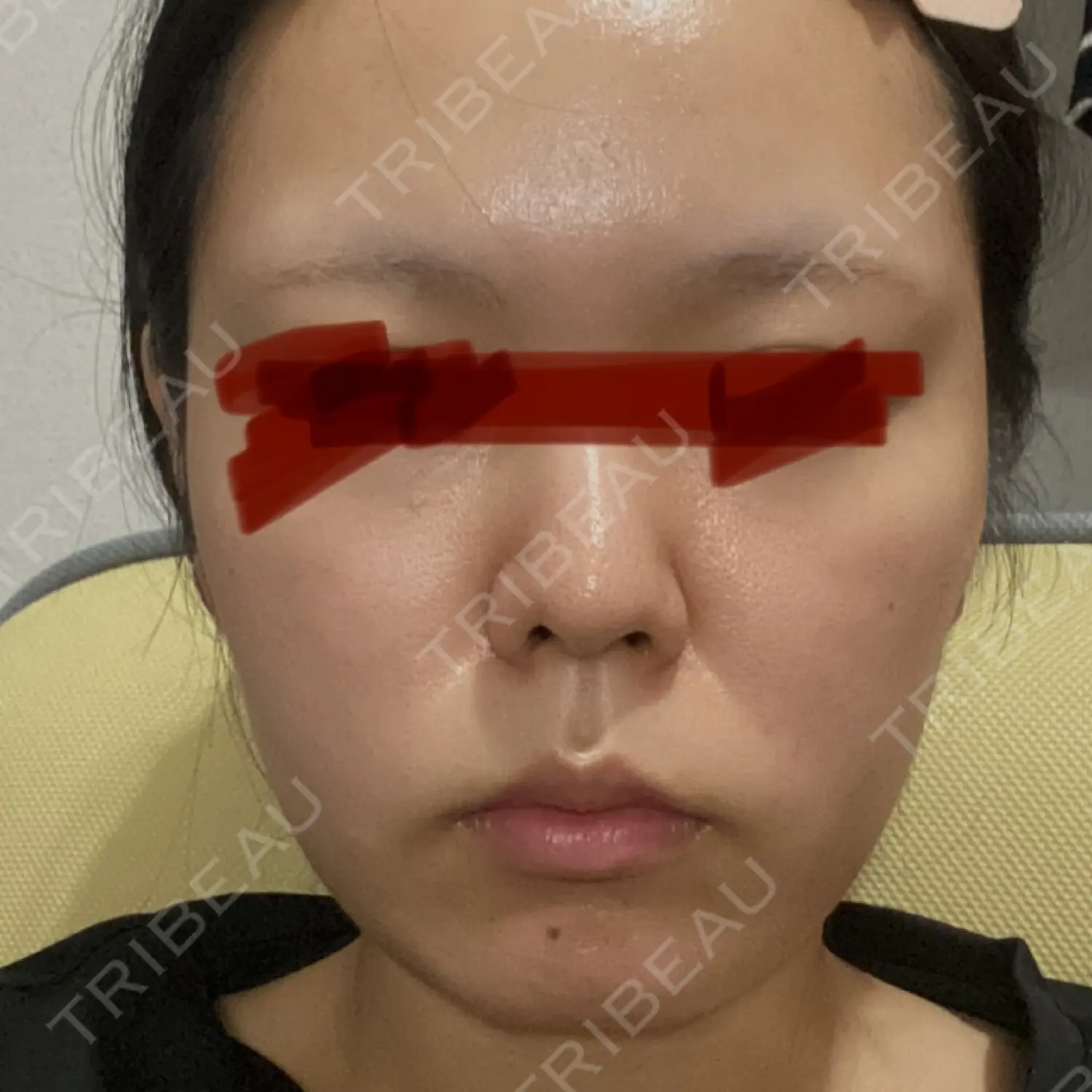 施術前の写真