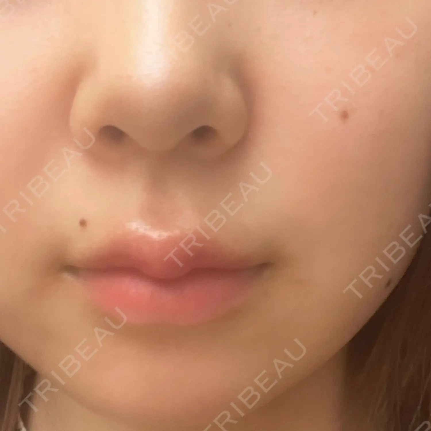 施術前の写真