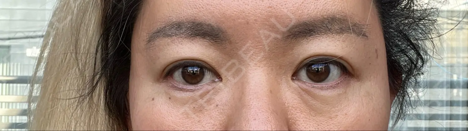 施術前の写真