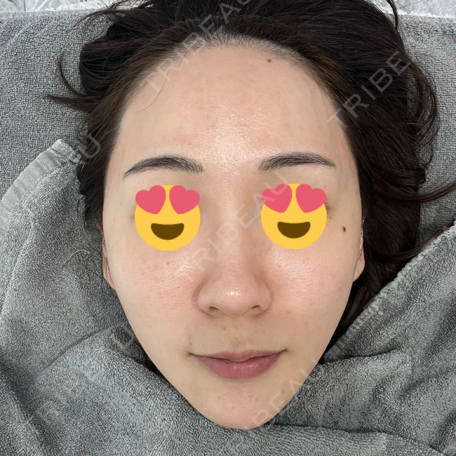 施術前の写真