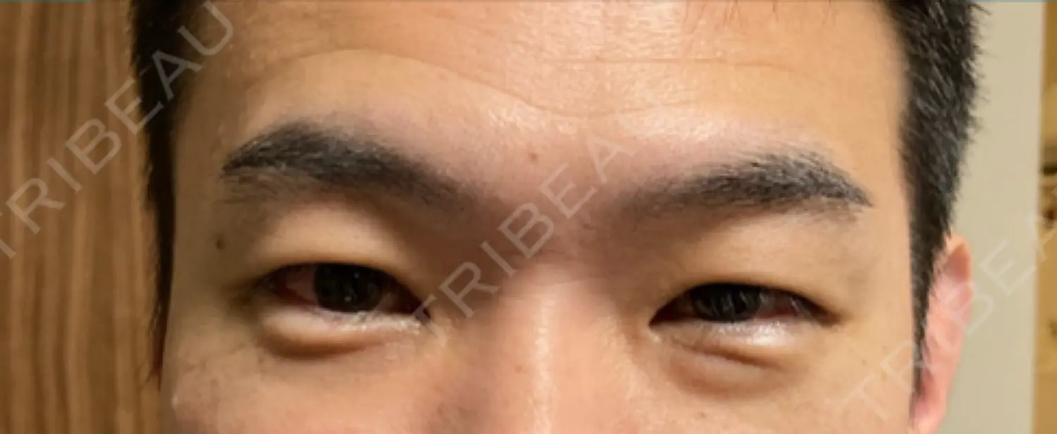 施術前の写真