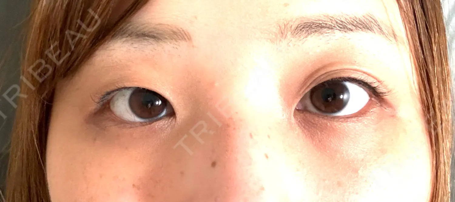施術前の写真