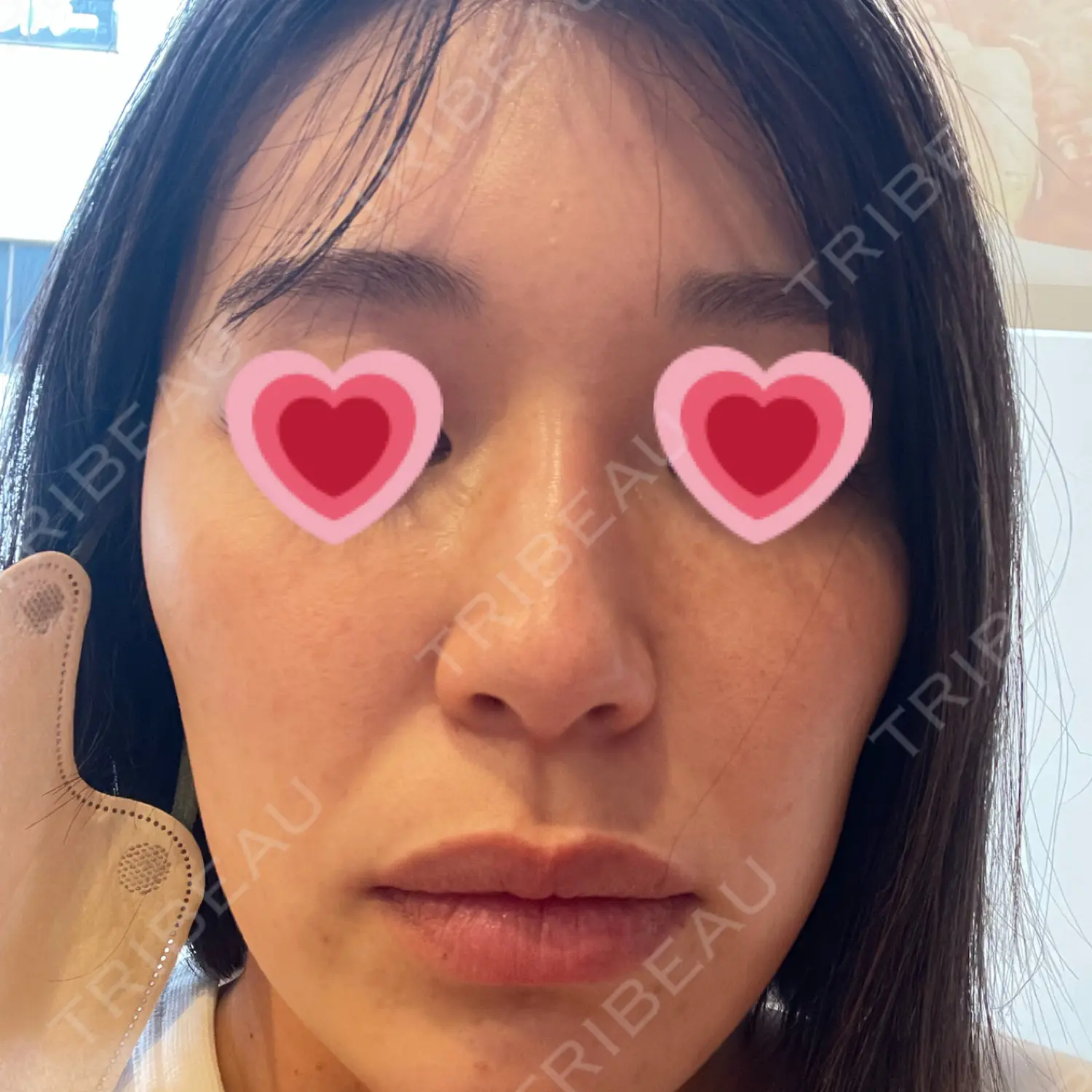 施術前の写真