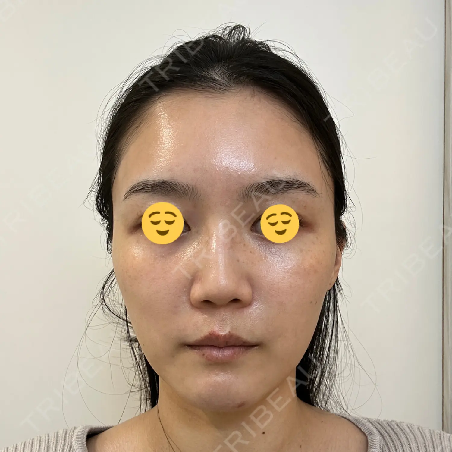 施術前の写真