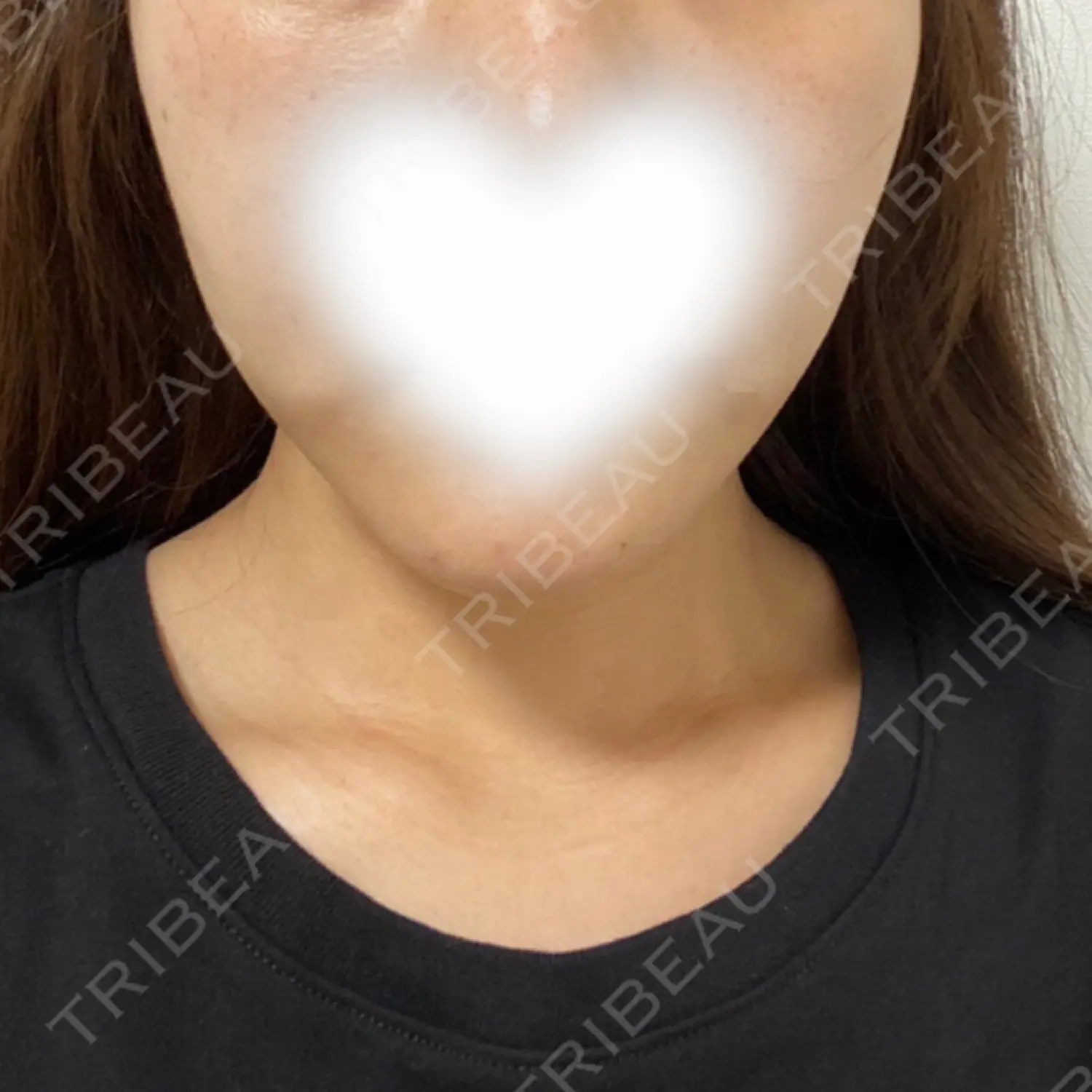 施術前の写真