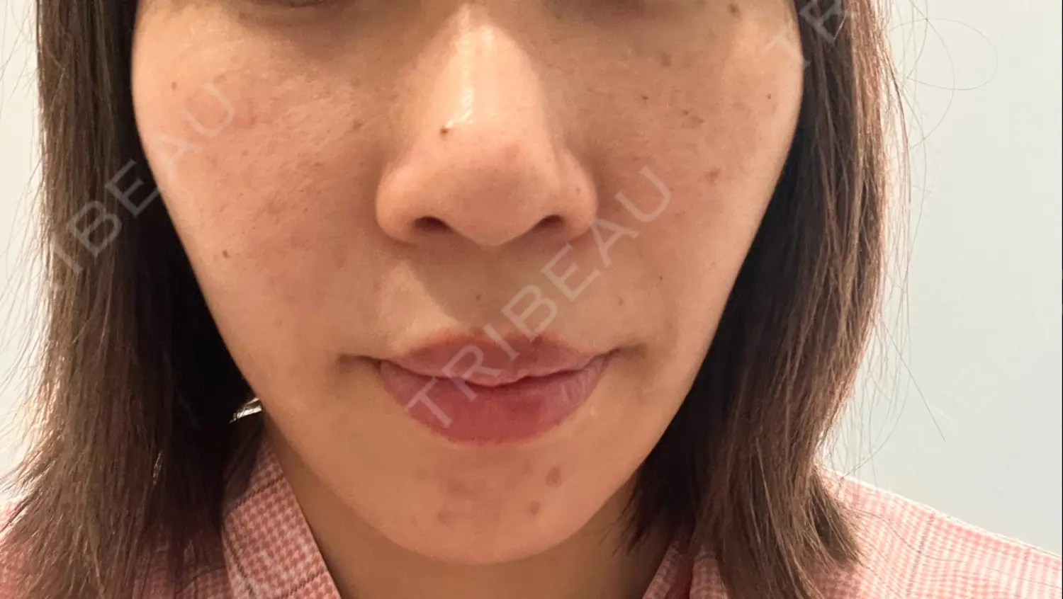 施術前の写真