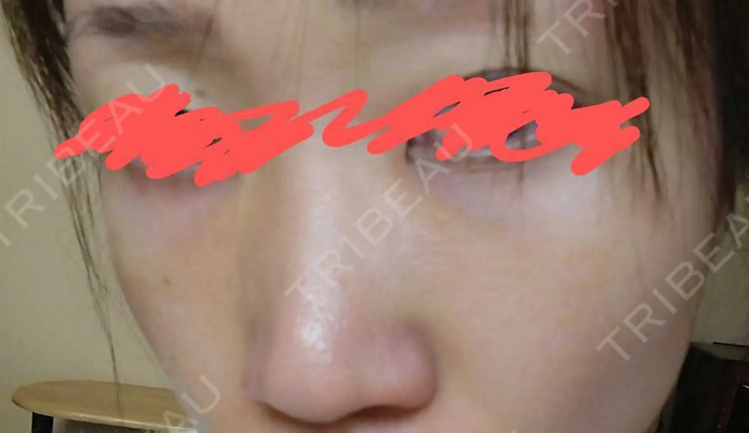 施術前の写真
