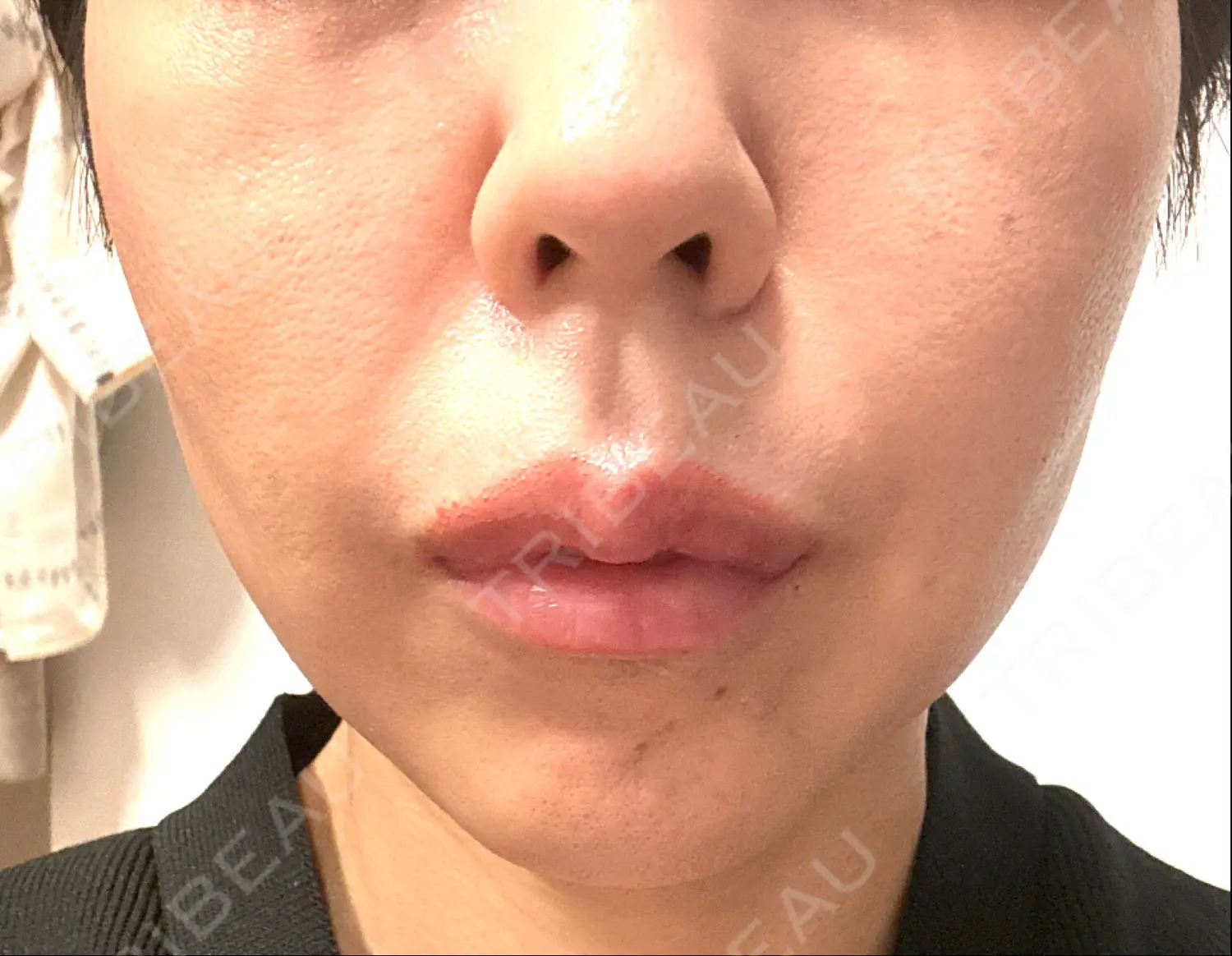 施術前の写真