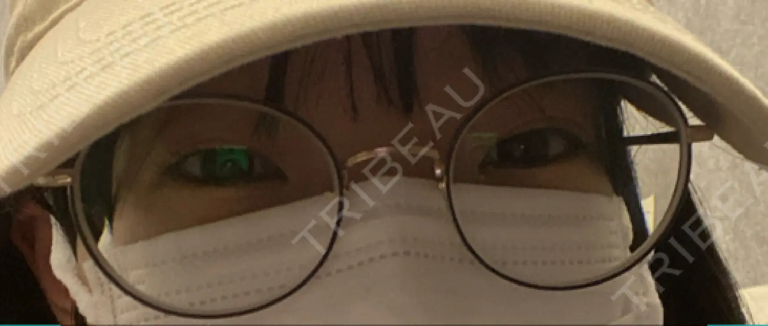施術前の写真
