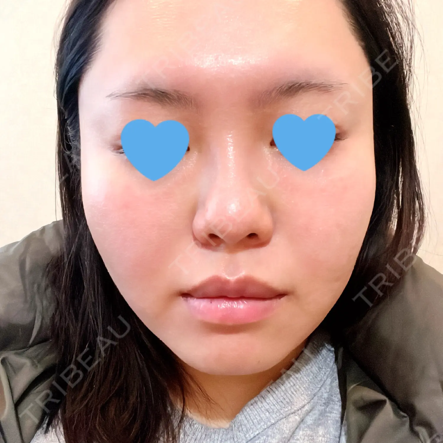 施術前の写真