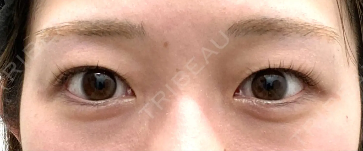 施術前の写真