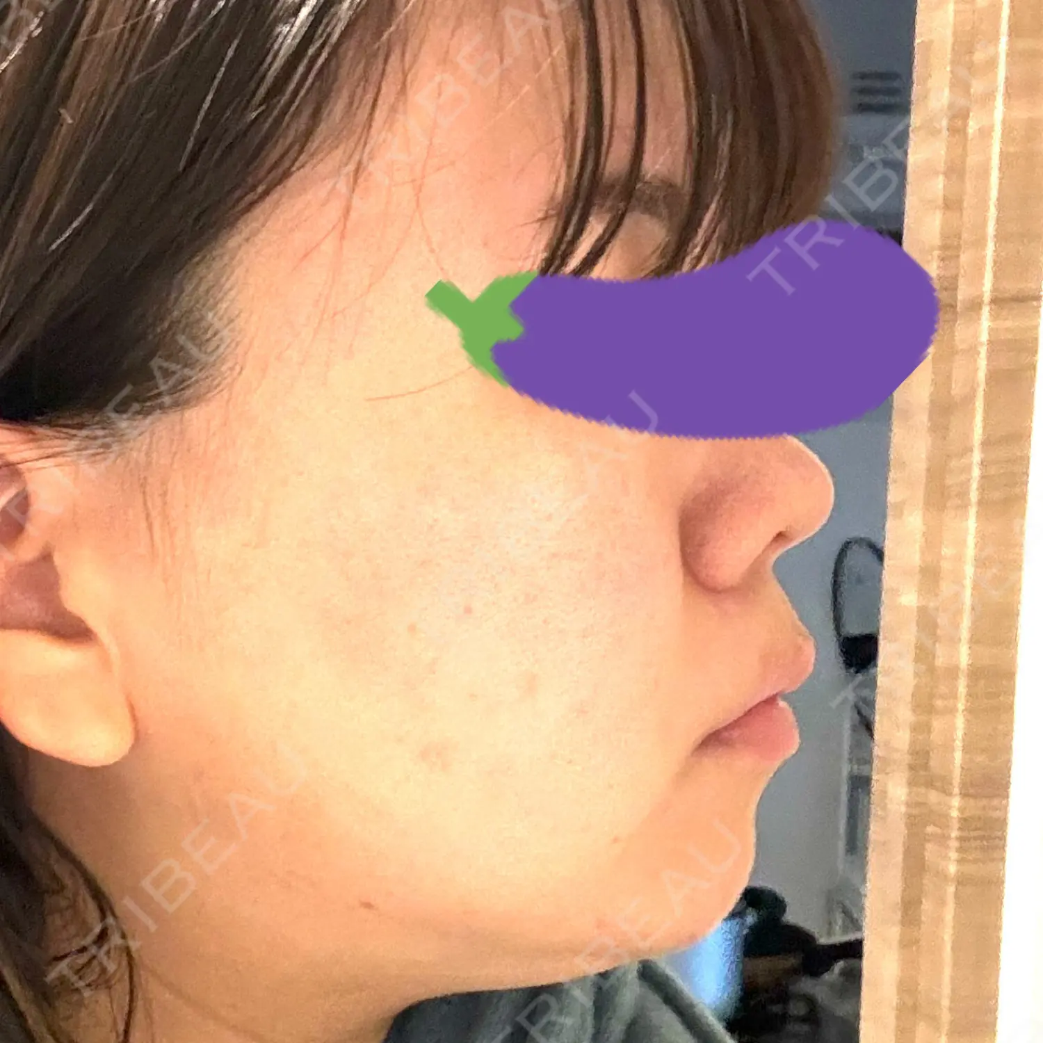施術前の写真