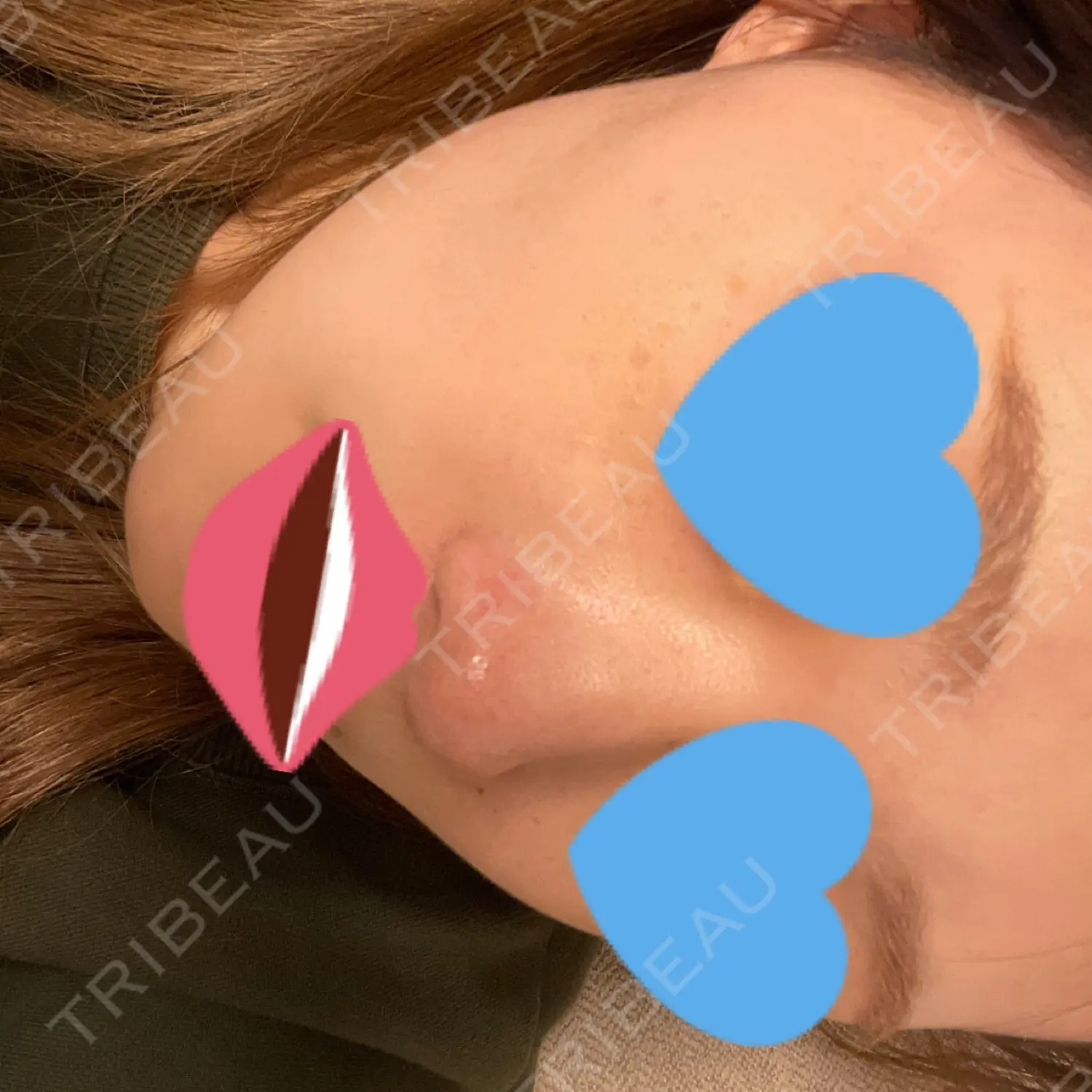 施術前の写真