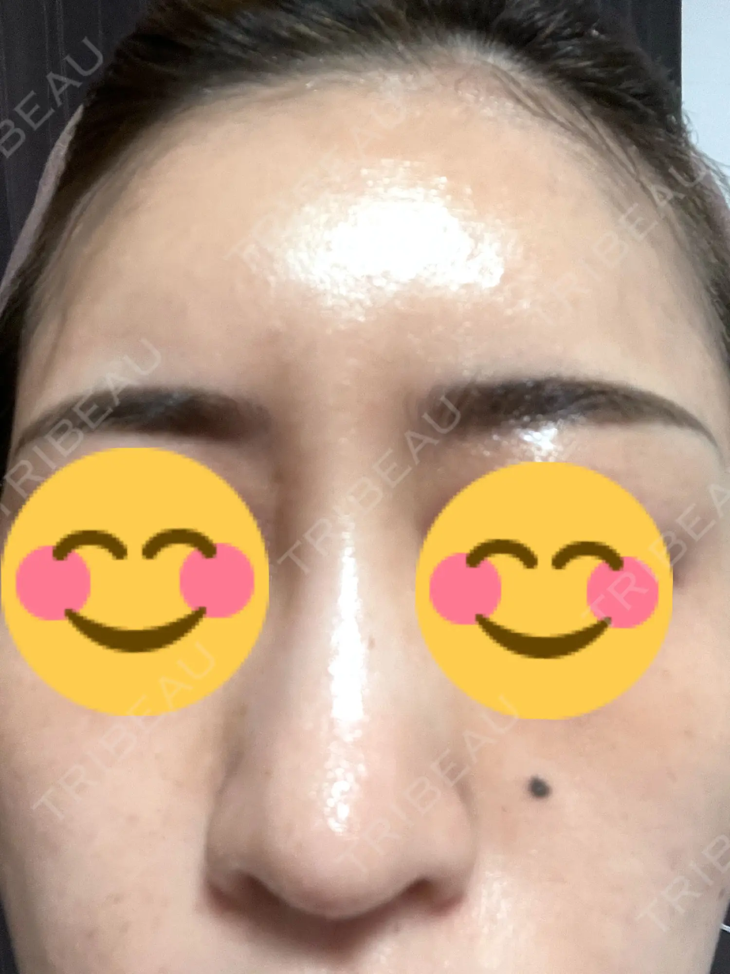 施術前の写真