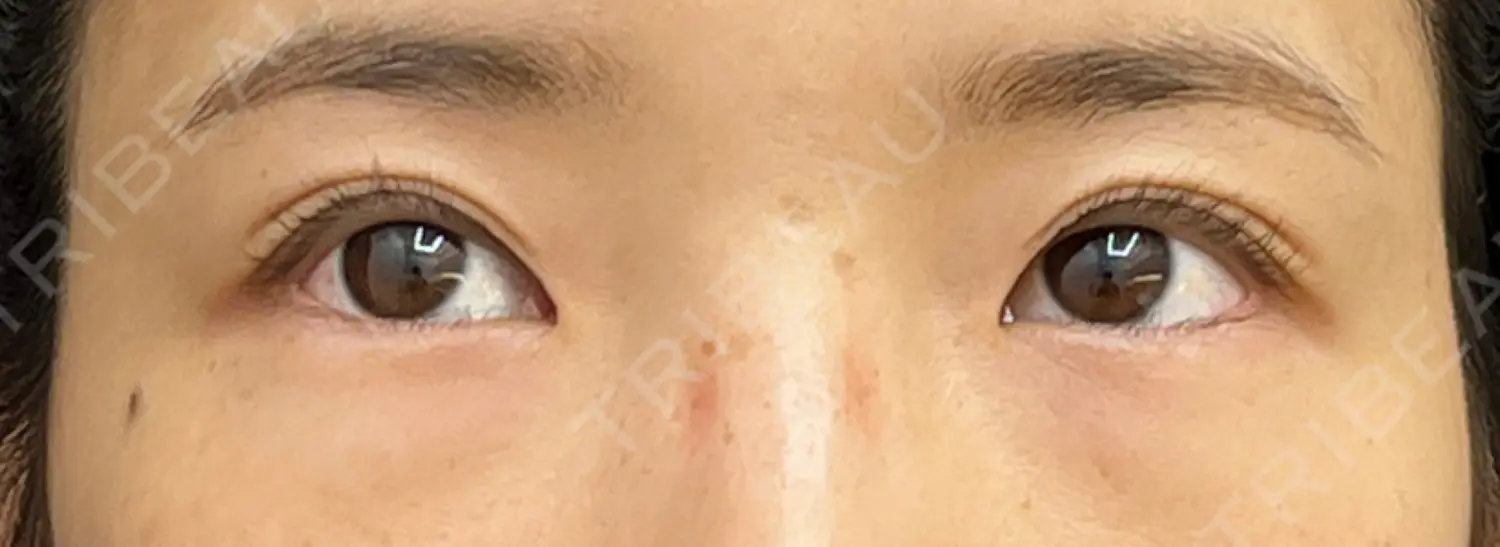 施術前の写真