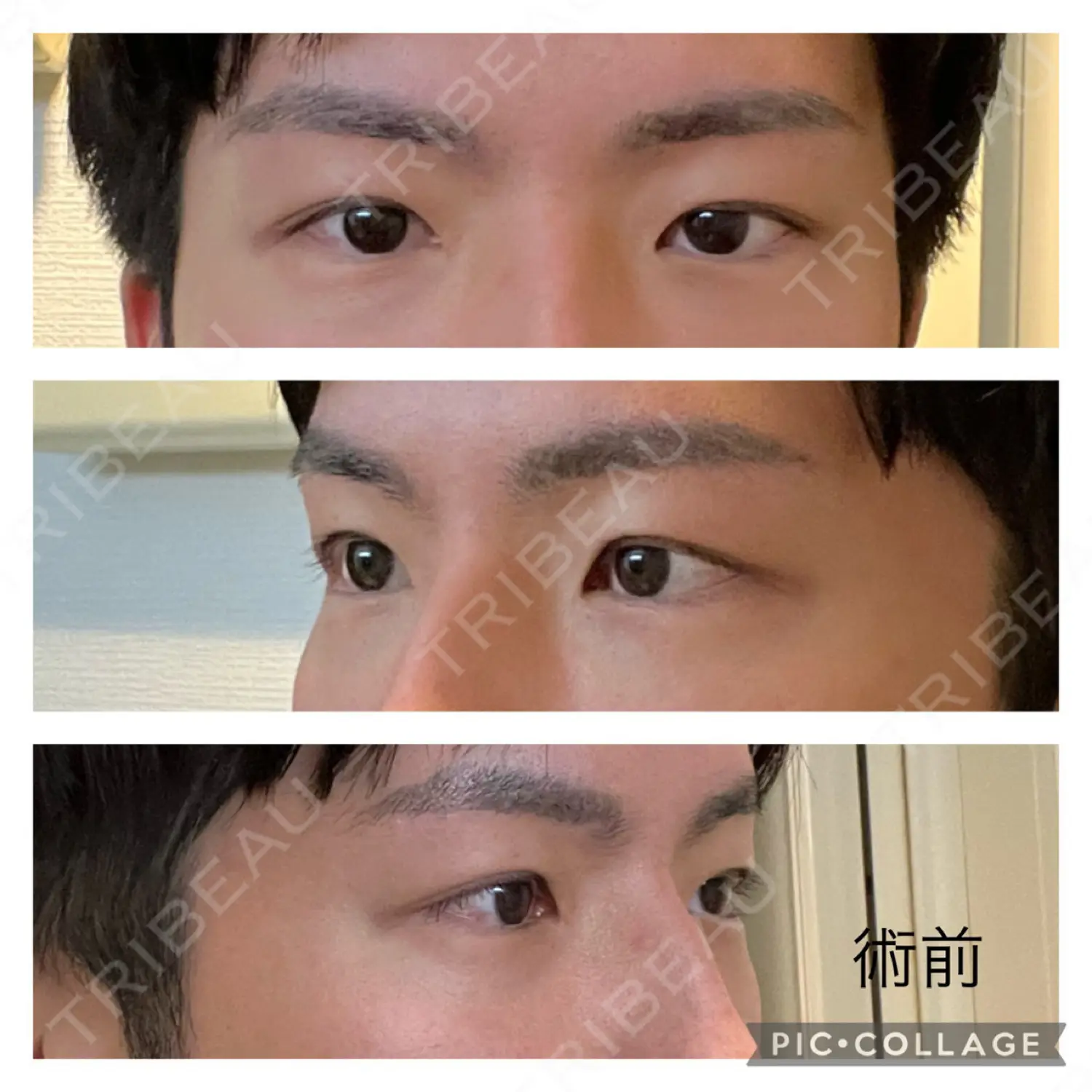 施術前の写真