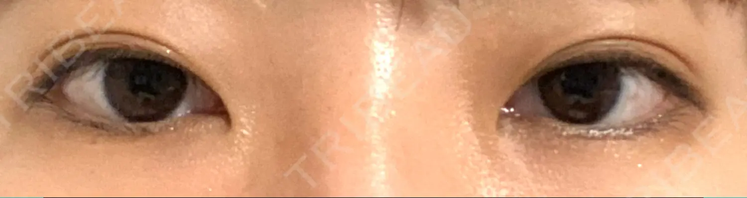 施術前の写真