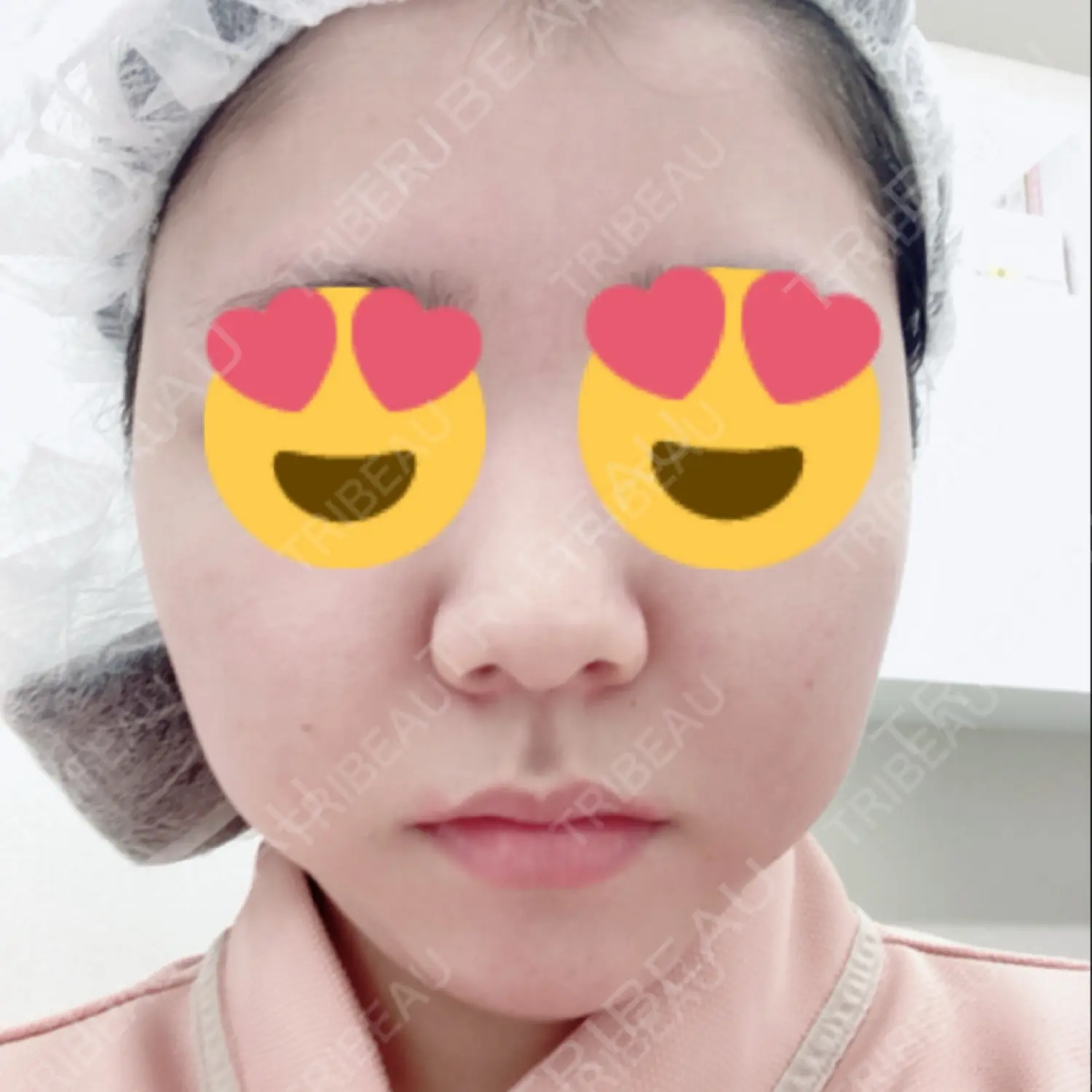 施術前の写真