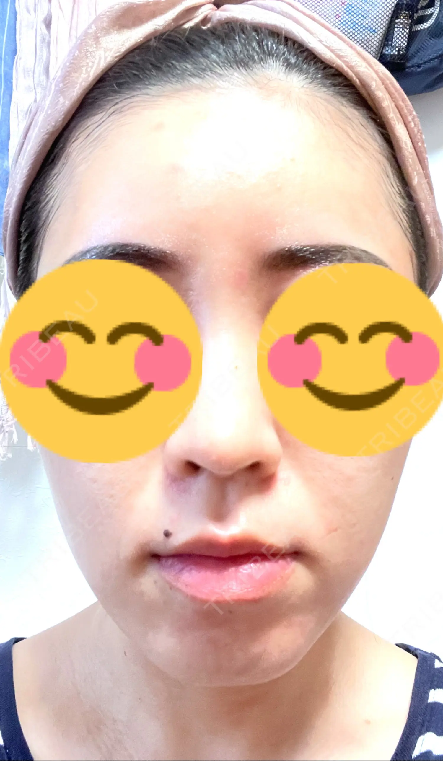 施術前の写真