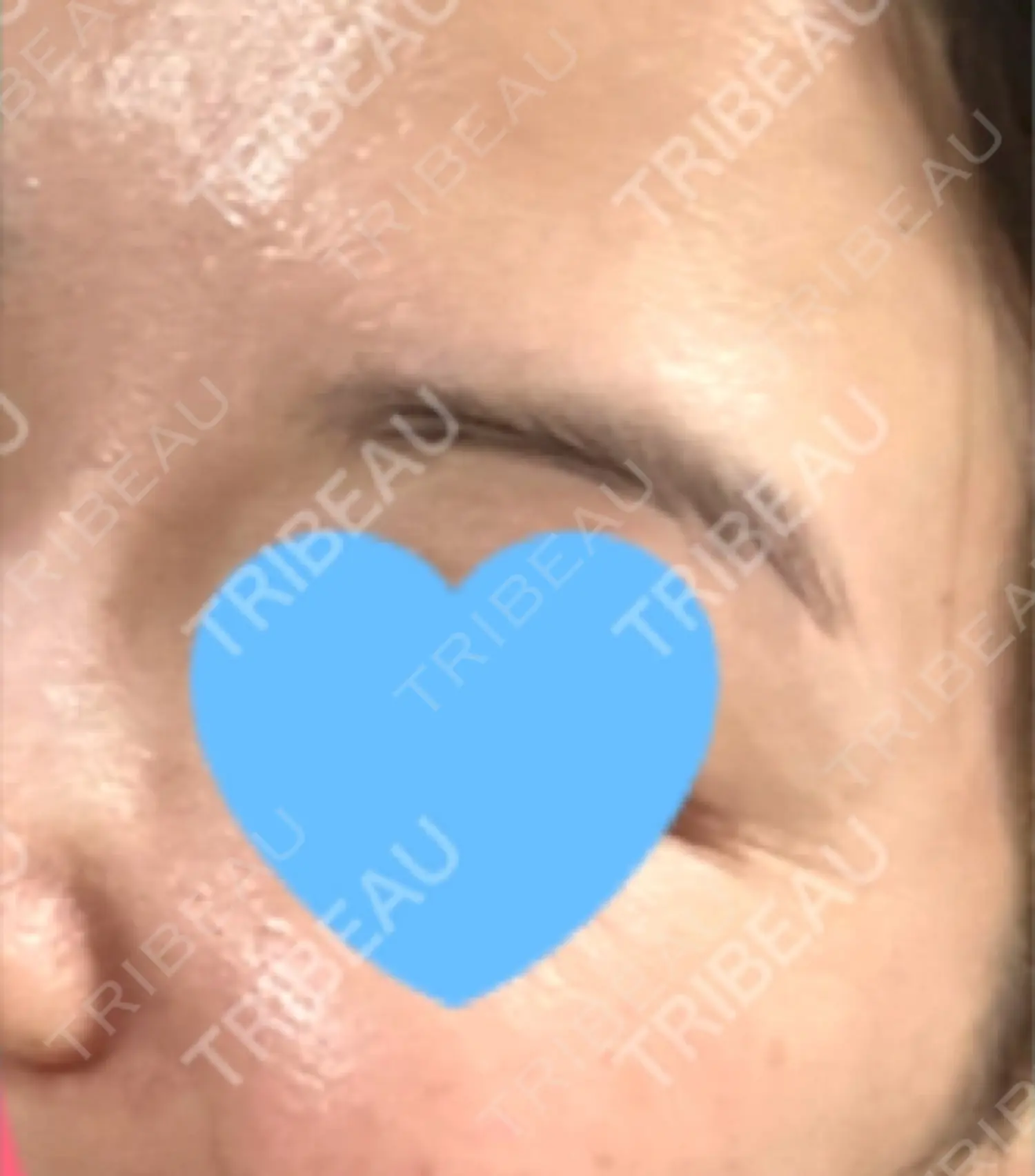 施術前の写真