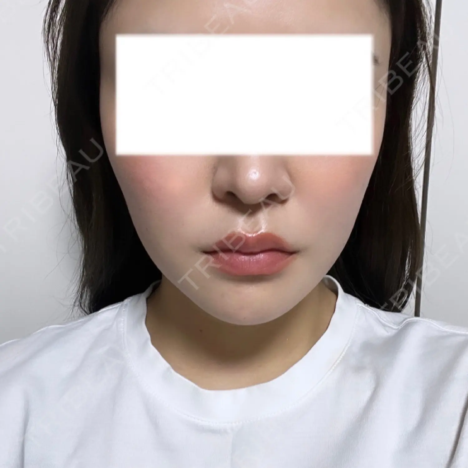 施術前の写真