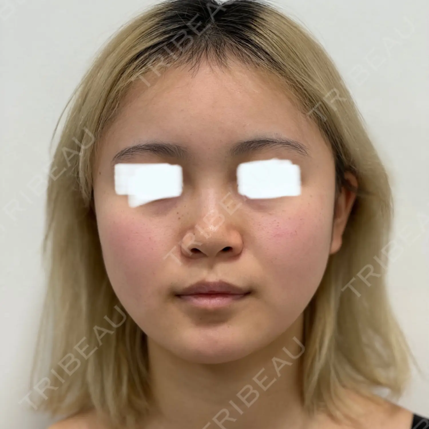 施術前の写真