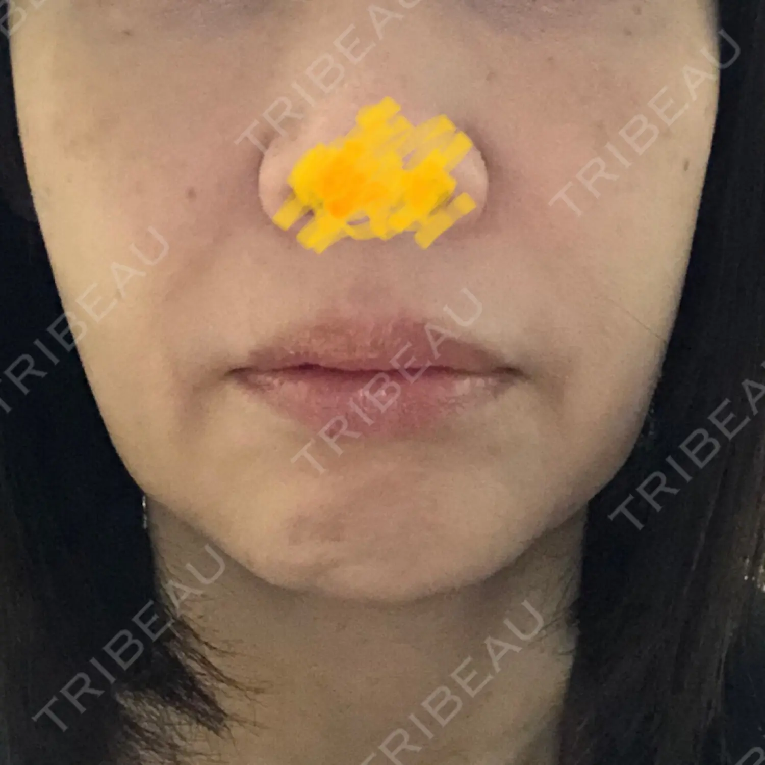施術前の写真