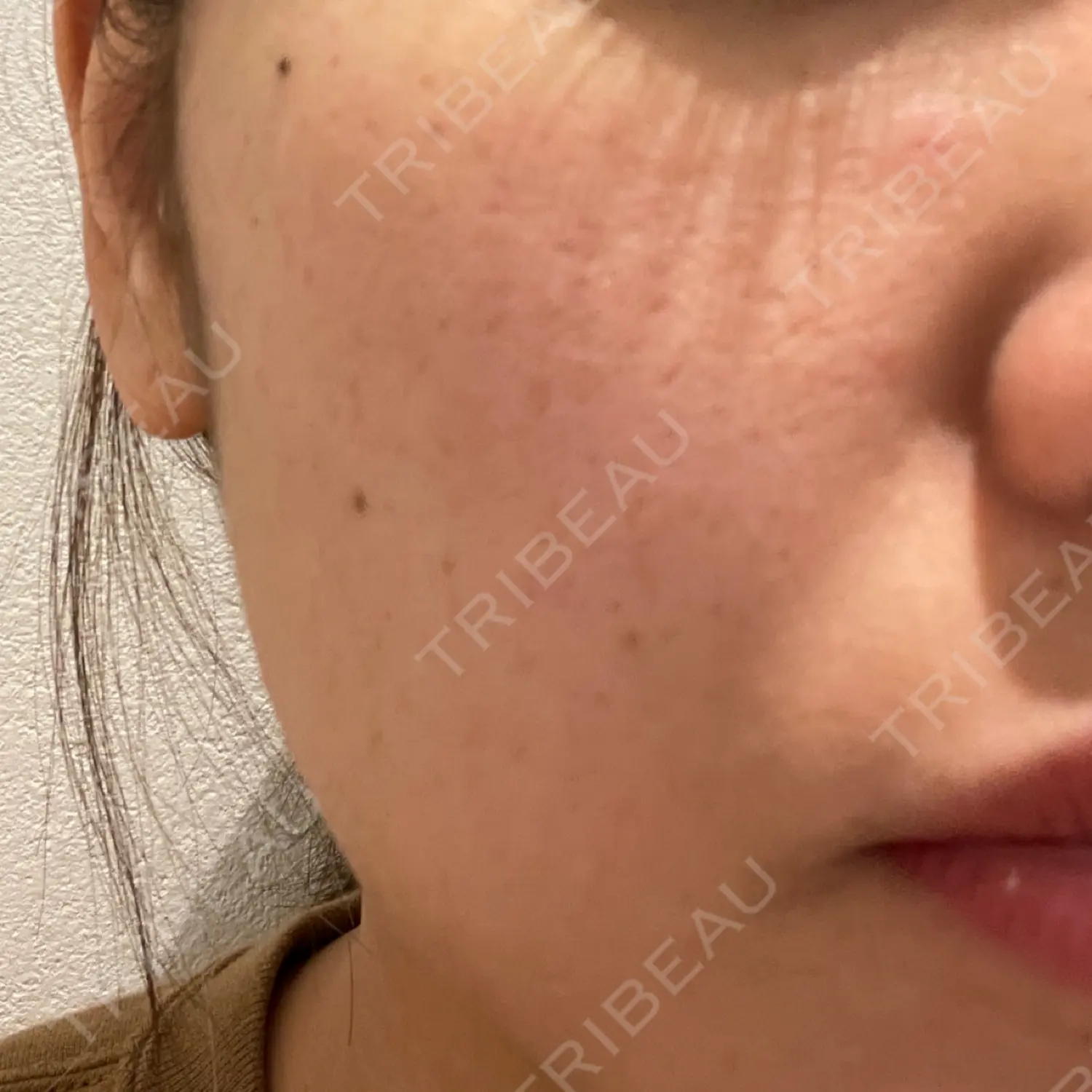 施術前の写真