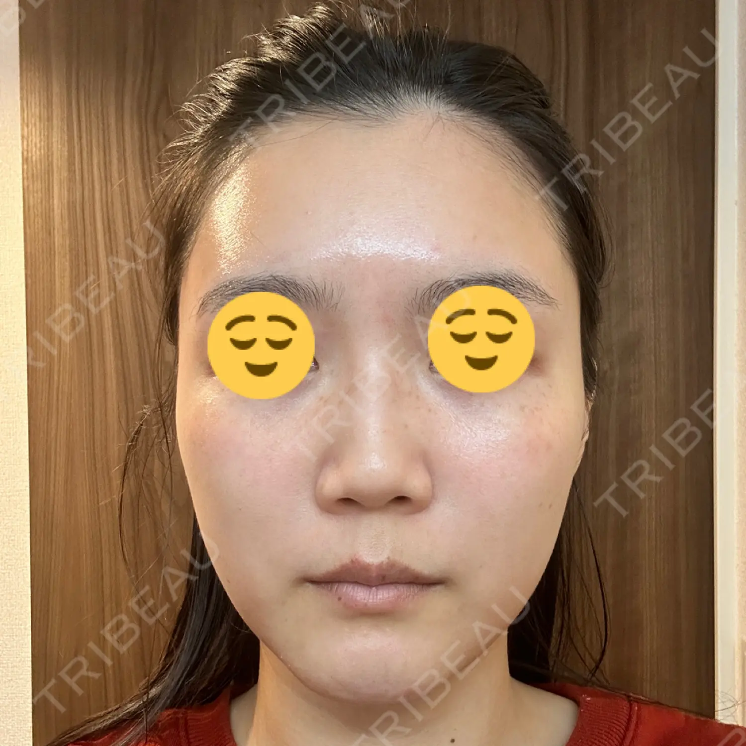 施術前の写真