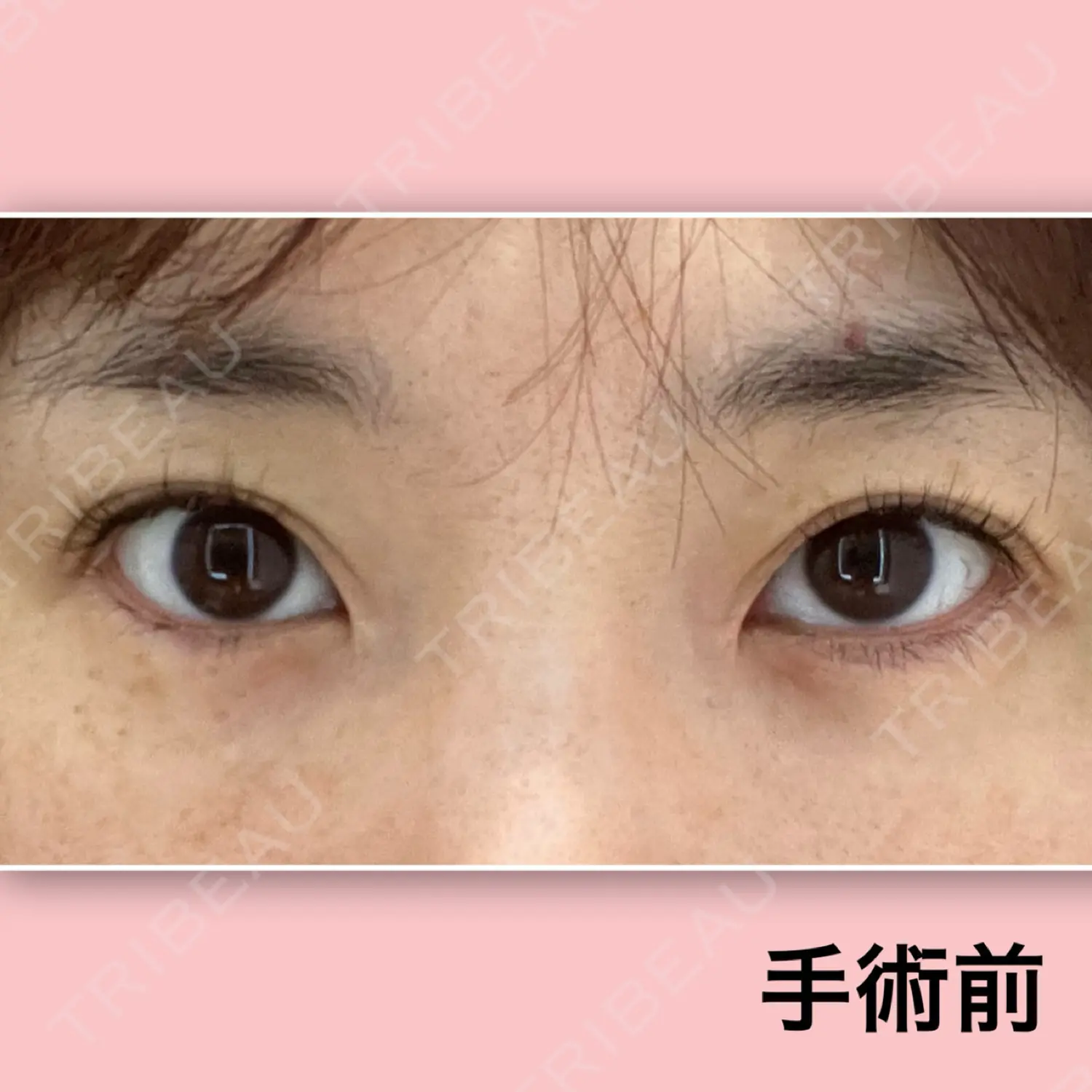 施術前の写真